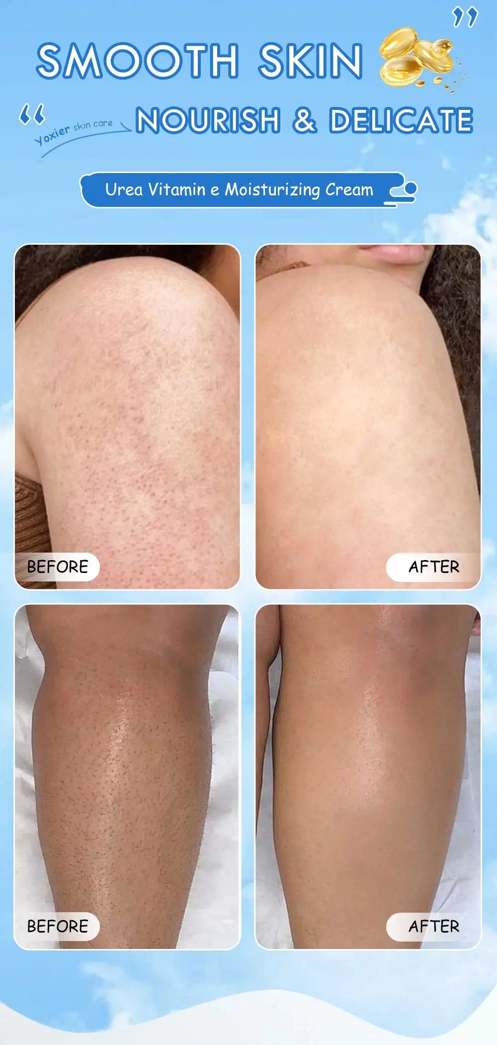 100g Chicken Skin Removal Cream Body Repair Keratosis Pilaris Rough Bumpy Pore Spots Dull Skin Care Whitening Moisturizing