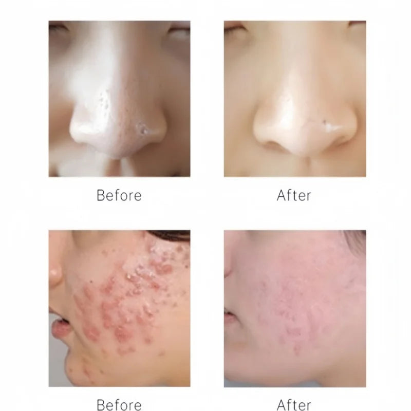 مجموعة مصل تقشير الوجه المائي لجهاز التجميل، تقشير البشرة، تقشير الوجه، ترطيب البشرة، تنظيف عميق