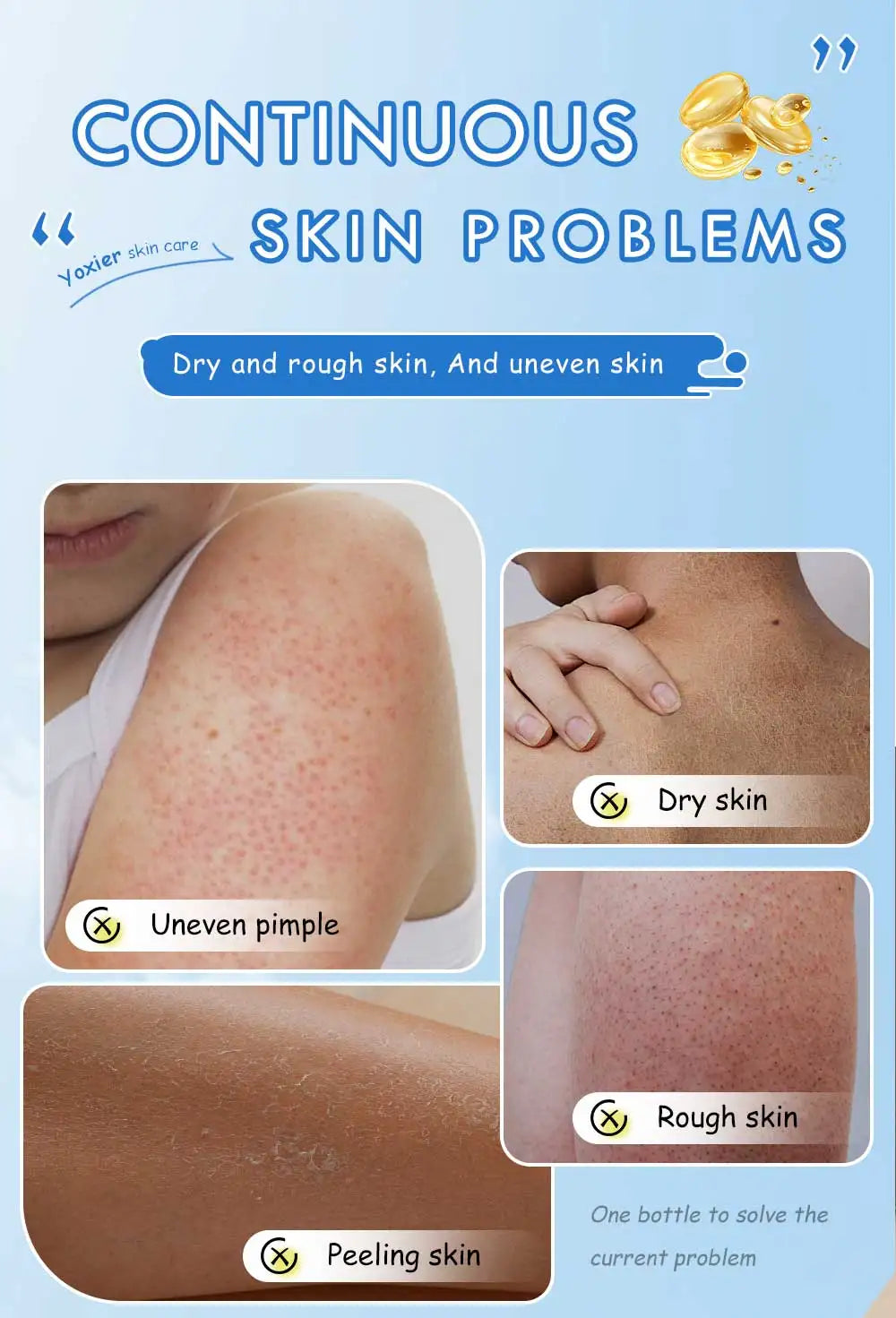 100g Chicken Skin Removal Cream Body Repair Keratosis Pilaris Rough Bumpy Pore Spots Dull Skin Care Whitening Moisturizing